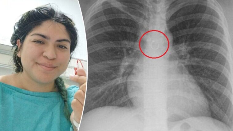 woman-discovers-missing-nose-ring-traveled-to-her-lungs,-causing-month-long-cough