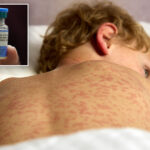 outbreak-of-world’s-most-contagious-disease-in-california-hits-highest-levels-in-nearly-a-decade