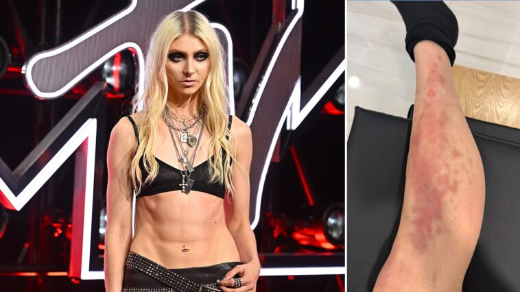taylor-momsen-rushed-to-hospital-after-venomous-spider-bite-during-ac/dc-tour