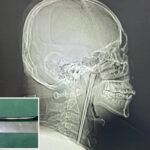 drunkard-spent-8-years-with-metal-chopstick-stuck-in-his-throat