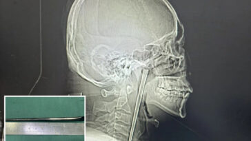 drunkard-spent-8-years-with-metal-chopstick-stuck-in-his-throat