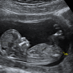 woman-stuns-crowd-at-far-left-uc-berkeley-with-powerful-prolife-message-(video)