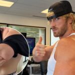 logan-paul-shows-off-gruesome-scar-after-undergoing-arm-surgery
