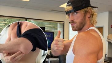 logan-paul-shows-off-gruesome-scar-after-undergoing-arm-surgery