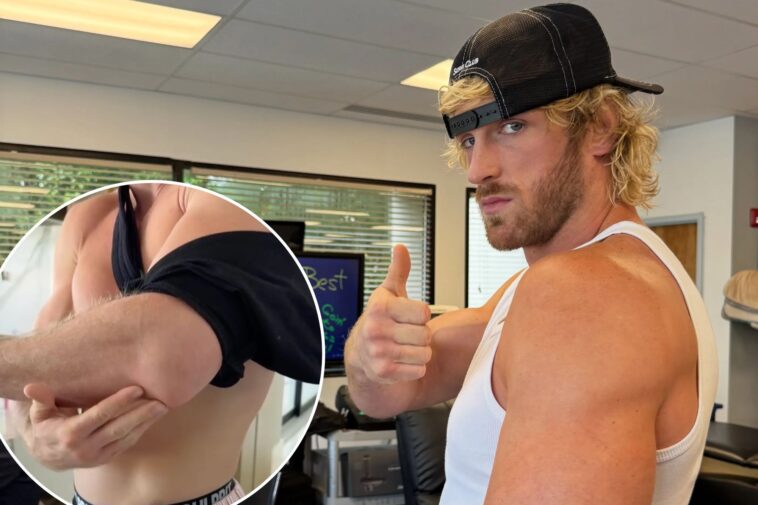 logan-paul-shows-off-gruesome-scar-after-undergoing-arm-surgery