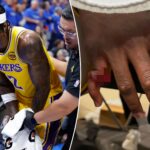 lakers’-jarred-vanderbilt-shares-graphic-photos-of-gruesome-finger-injury:-‘looks-like-a-chicken-wing’