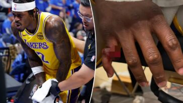 lakers’-jarred-vanderbilt-shares-graphic-photos-of-gruesome-finger-injury:-‘looks-like-a-chicken-wing’