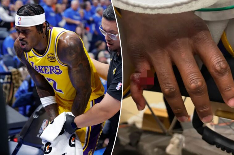 lakers’-jarred-vanderbilt-shares-graphic-photos-of-gruesome-finger-injury:-‘looks-like-a-chicken-wing’
