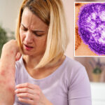 measles-emerges-in-california-wastewater-as-health-experts-sound-alarm