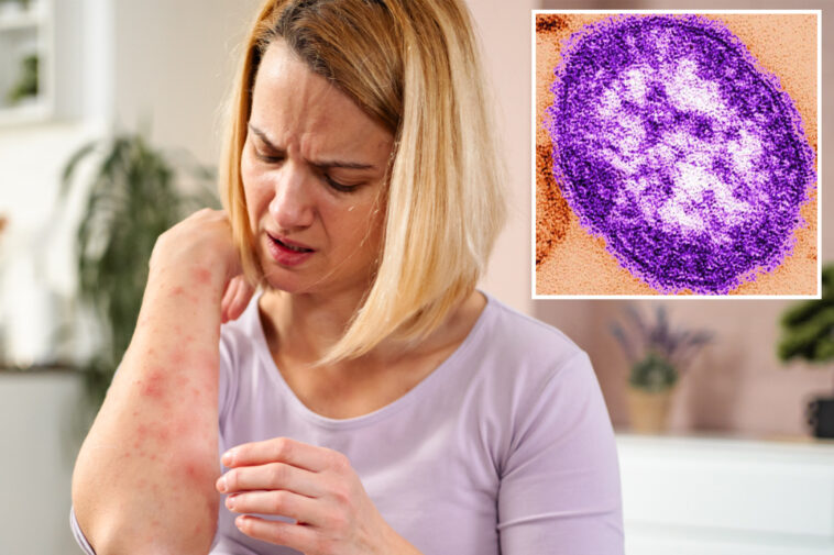 measles-emerges-in-california-wastewater-as-health-experts-sound-alarm