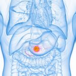 popular-‘healthy’-fat-found-to-fuel-deadly-pancreatic-cancer