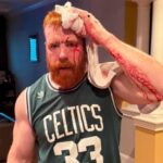 wwe-star-sheamus-shows-off-gruesome-head-injury-in-bloody-‘gym-fail’