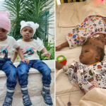 conjoined-twins-separated-after-19-months-with-fused-skulls-see-each-other-for-first-time