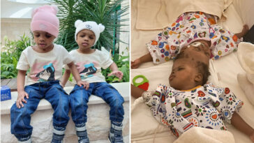 conjoined-twins-separated-after-19-months-with-fused-skulls-see-each-other-for-first-time