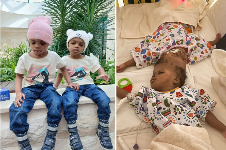 conjoined-twins-separated-after-19-months-with-fused-skulls-see-each-other-for-first-time