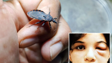 case-of-deadly-‘kissing-bug’-found-in-california-—-and-sufferers-may-not-even-know-they-have-it