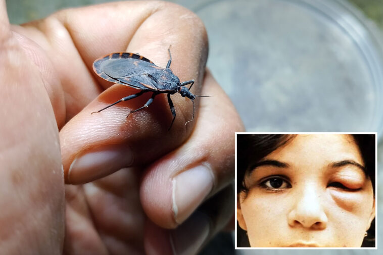 case-of-deadly-‘kissing-bug’-found-in-california-—-and-sufferers-may-not-even-know-they-have-it