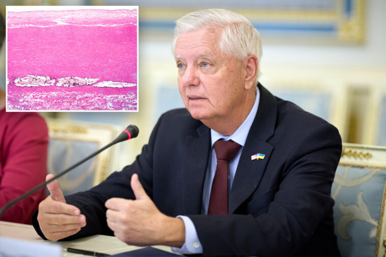 heart-condition-tied-to-lindsey-graham’s-death-can-strike-without-warning:-experts