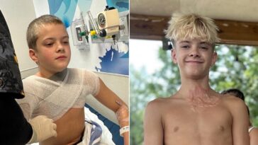 microwaved-squishy-toy-explodes-onto-boy’s-face-and-chest-amid-viral-trend,-causing-horrific-burns