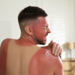how-to-know-when-sunburn-becomes-something-to-worry-about-—-and-how-to-treat-it