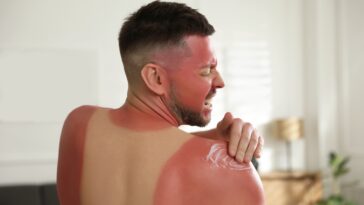 how-to-know-when-sunburn-becomes-something-to-worry-about-—-and-how-to-treat-it