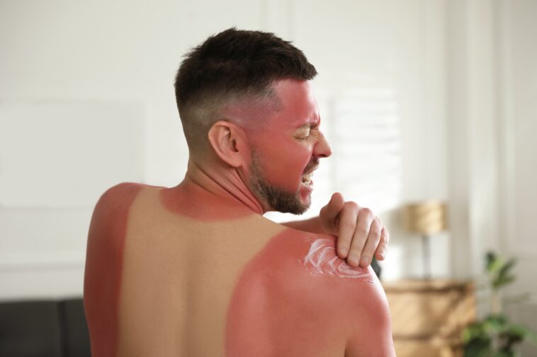 how-to-know-when-sunburn-becomes-something-to-worry-about-—-and-how-to-treat-it