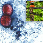 ‘explosive-diarrhea’-parasite-spreads-to-50-in-suffolk-county-as-long-island-deals-with-duel-outbreaks