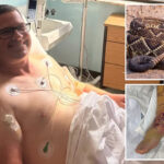 snakebite-victim-who-sucked-up-hospital’s-entire-supply-of-anti-venom-hit-with-staggering-medical-bill