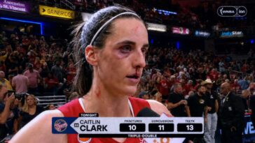 caitlin-clark-records-triple-double-with-10-fractures,-11-concussions,-13-teeth-knocked-out