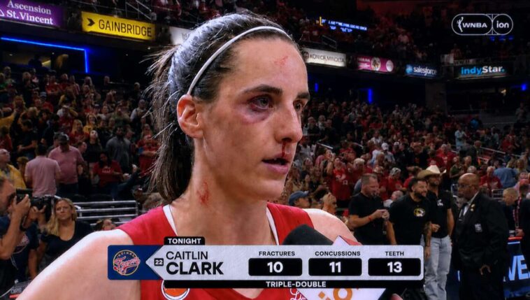 caitlin-clark-records-triple-double-with-10-fractures,-11-concussions,-13-teeth-knocked-out
