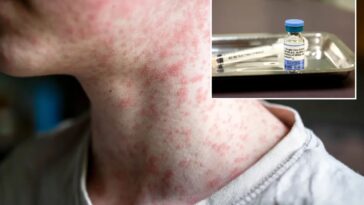 us-hits-most-cases-of-‘world’s-most-contagious-disease’-in-35-years-—-and-it’s-only-july