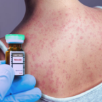 a-disease-once-thought-defeated-is-spreading-across-america