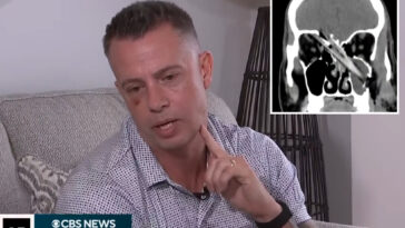 nj-dad-miraculously-survives-after-‘huge’-tree-branch-impales-his-jaw-into-his-brain:-‘mind-boggling’