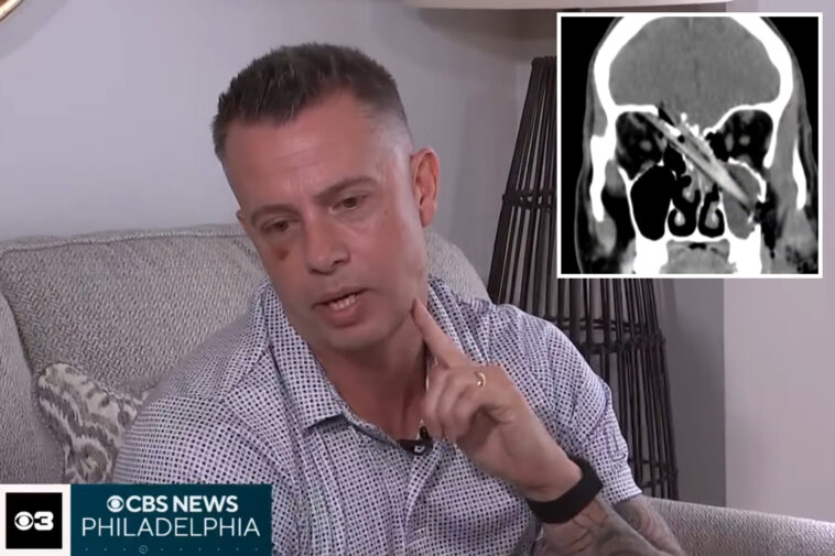 nj-dad-miraculously-survives-after-‘huge’-tree-branch-impales-his-jaw-into-his-brain:-‘mind-boggling’