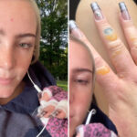 nyc-woman-warns-against-getting-painful,-blistering-‘margarita-burn’-by-avoiding-this-common-summer-activity