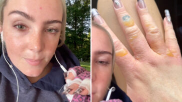 nyc-woman-warns-against-getting-painful,-blistering-‘margarita-burn’-by-avoiding-this-common-summer-activity
