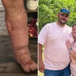 horrifying-reality-of-flesh-eating-bacteria-that-caused-florida-man’s-leg-to-swell-to-8-times-its-size