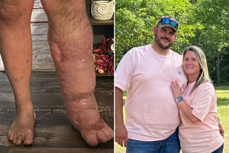 horrifying-reality-of-flesh-eating-bacteria-that-caused-florida-man’s-leg-to-swell-to-8-times-its-size