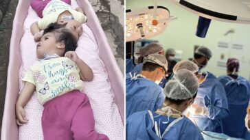 conjoined-twin-girls,-2,-die-in-desperate-surgical-operation-minutes-after-being-separated