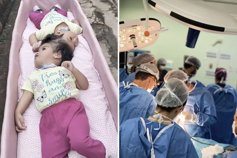 conjoined-twin-girls,-2,-die-in-desperate-surgical-operation-minutes-after-being-separated
