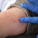 deadly-measles-outbreak-hits-northeast-as-state-records-first-deaths-in-35-years