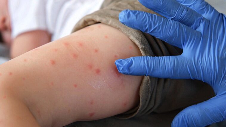 deadly-measles-outbreak-hits-northeast-as-state-records-first-deaths-in-35-years