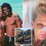 top-surfer-and-his-wife-show-their-horrific-injuries-after-being-mangled-in-california-crash