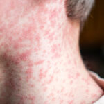pennsylvania:-two-die-from-measles,-first-in-35-years