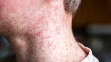 pennsylvania:-two-die-from-measles,-first-in-35-years