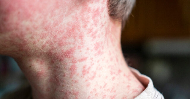 pennsylvania:-two-die-from-measles,-first-in-35-years