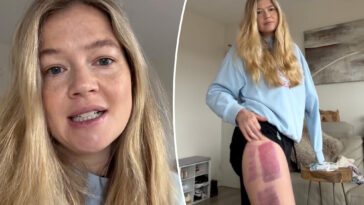 ‘devastated’-shark-attack-survivor-who-lost-an-arm-shares-sad-health-news-months-after-terrifying-incident