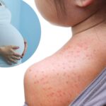‘we’re-literally-seeing-new-forms-of-measles’:-infectious-disease-doc-warns-about-scary-pennsylvania-development