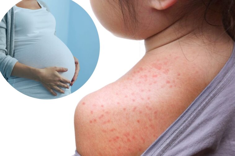‘we’re-literally-seeing-new-forms-of-measles’:-infectious-disease-doc-warns-about-scary-pennsylvania-development