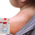 ny-declares-state-disaster-emergency-over-measles-outbreak-in-rural-communities